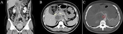 Laparoscopic resection of a paraganglioma behind the retrohepatic segment of the inferior vena cava: a case report and literature review